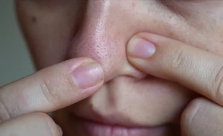 How to Rid of Nose Blackheads Permanently: Expert Backed Solutions